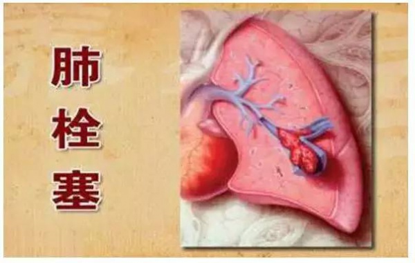 99%的血栓無(wú)征兆！記住一個(gè)字，讓你遠(yuǎn)離這個(gè)游走血管的幽靈