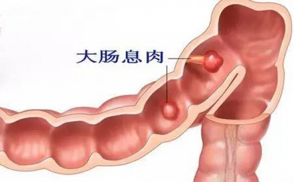 體檢中發(fā)現(xiàn)胃腸息肉怎么辦，切還是不切？九成腸癌由息肉轉(zhuǎn)變而來